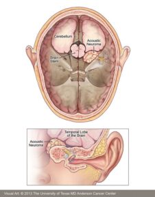 Schwannoma vestibular. Esquema de un corte axial y coronal.