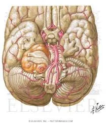Neurinoma del acústico. Esquema de la compresión de estructuras próximas. Neurinoma del acústico. Compresión de estructuras próximas.