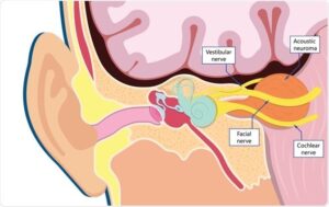Neurinoma del acústico. Esquema de un corte coronal.