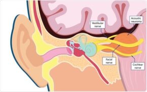 Neurinoma del acústico. Esquema de un corte coronal.
