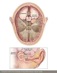 Schwannoma vestibular. Esquema corte axial y coronal.