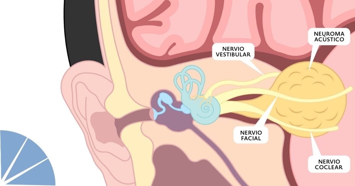 Schwannoma vestibular